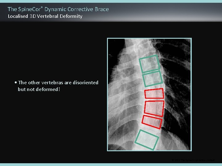 The Spine. Cor® Dynamic Corrective Brace Localised 3 D Vertebral Deformity • The other