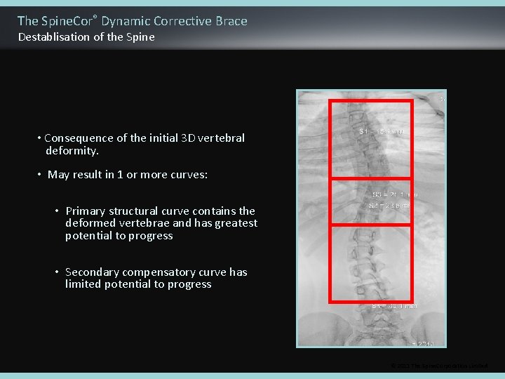 The Spine. Cor® Dynamic Corrective Brace Destablisation of the Spine • Consequence of the