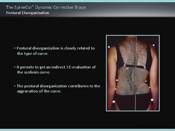 The Spine. Cor® Dynamic Corrective Brace Postural Disorganisation • Postural disorganization is closely related