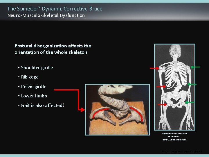 The Spine. Cor® Dynamic Corrective Brace Neuro-Musculo-Skeletal Dysfunction Postural disorganization affects the orientation of