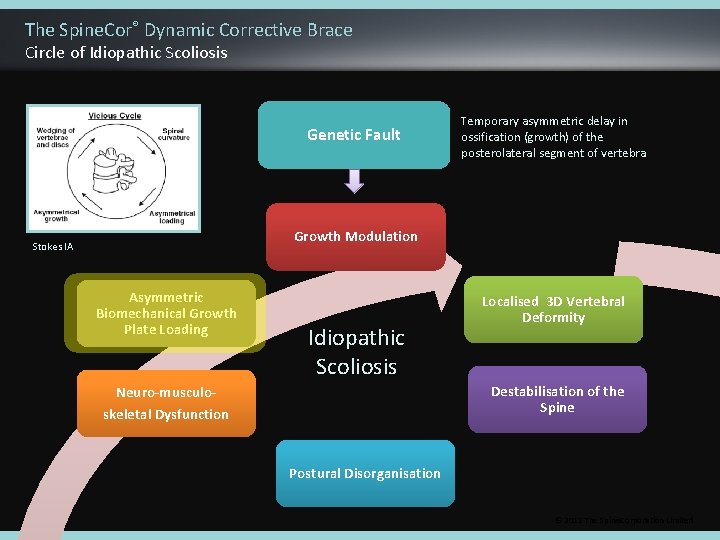 The Spine. Cor® Dynamic Corrective Brace Circle of Idiopathic Scoliosis Genetic Fault Temporary asymmetric