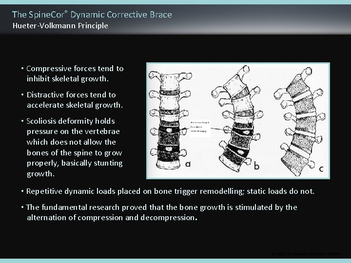 The Spine. Cor® Dynamic Corrective Brace Hueter-Volkmann Principle • Compressive forces tend to inhibit