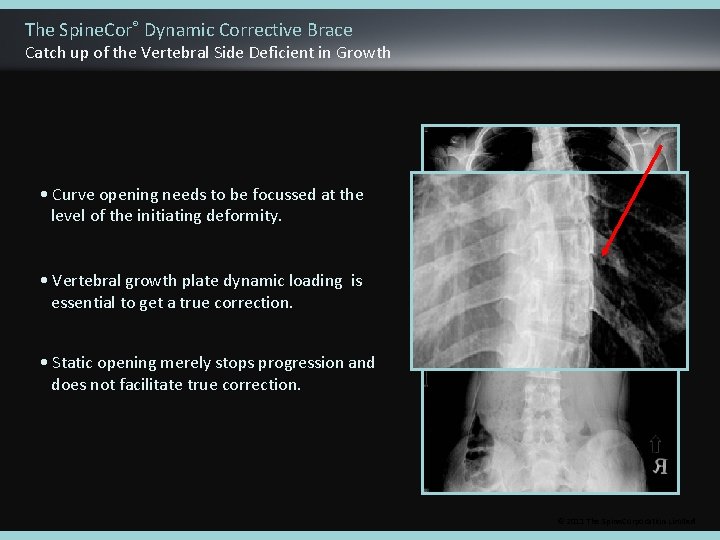 The Spine. Cor® Dynamic Corrective Brace Catch up of the Vertebral Side Deficient in