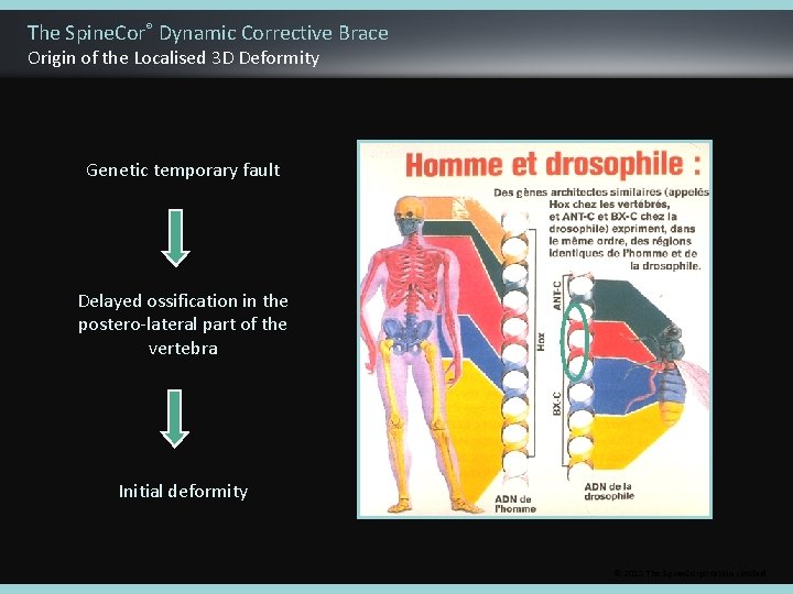 The Spine. Cor® Dynamic Corrective Brace Origin of the Localised 3 D Deformity Genetic