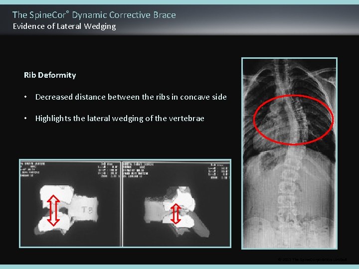 The Spine. Cor® Dynamic Corrective Brace Evidence of Lateral Wedging Rib Deformity • Decreased