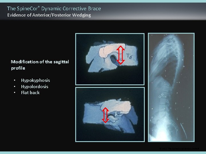 The Spine. Cor® Dynamic Corrective Brace Evidence of Anterior/Posterior Wedging Modification of the sagittal
