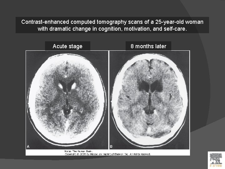 Contrast-enhanced computed tomography scans of a 25 -year-old woman with dramatic change in cognition,