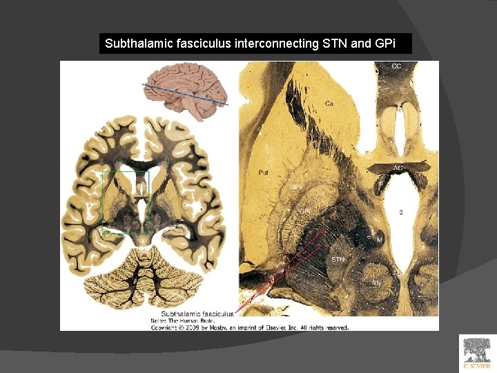 Subthalamic fasciculus interconnecting STN and GPi 