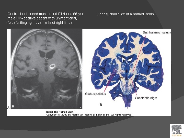 Contrast-enhanced mass in left STN of a 65 y/o male HIV-positive patient with unintentional,