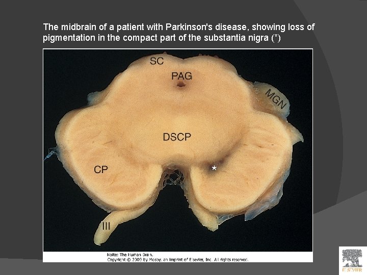 The midbrain of a patient with Parkinson's disease, showing loss of pigmentation in the