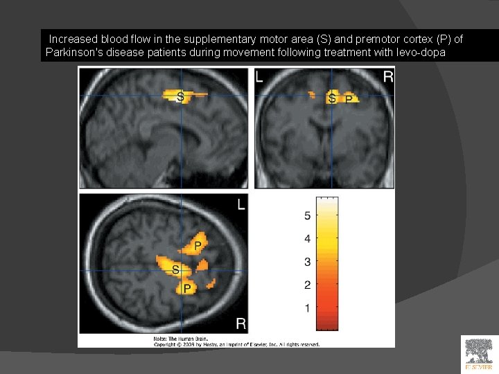 Increased blood flow in the supplementary motor area (S) and premotor cortex (P) of
