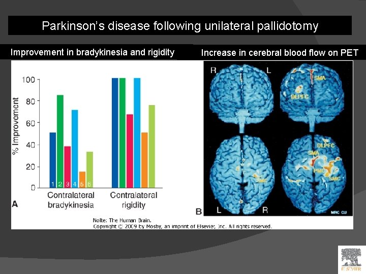 Parkinson’s disease following unilateral pallidotomy Improvement in bradykinesia and rigidity Increase in cerebral blood