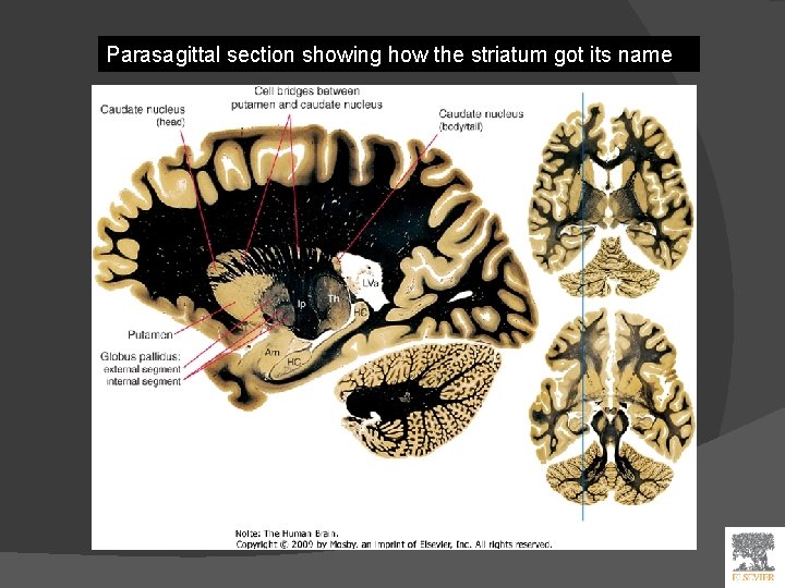 Parasagittal section showing how the striatum got its name 