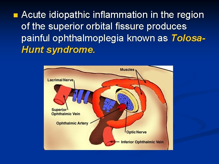 n Acute idiopathic inflammation in the region of the superior orbital fissure produces painful