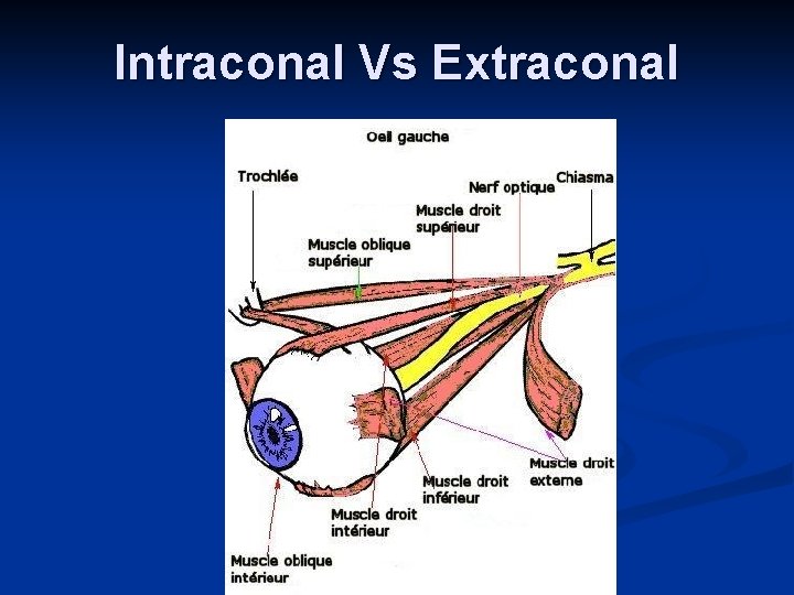 Intraconal Vs Extraconal 