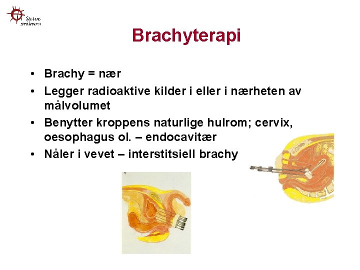 Brachyterapi • Brachy = nær • Legger radioaktive kilder i eller i nærheten av