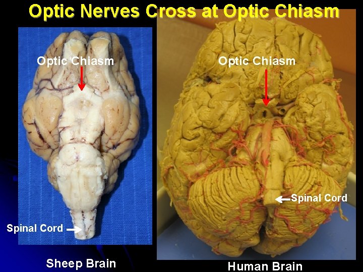 Optic Nerves Cross at Optic Chiasm Spinal Cord Sheep Brain Human Brain 