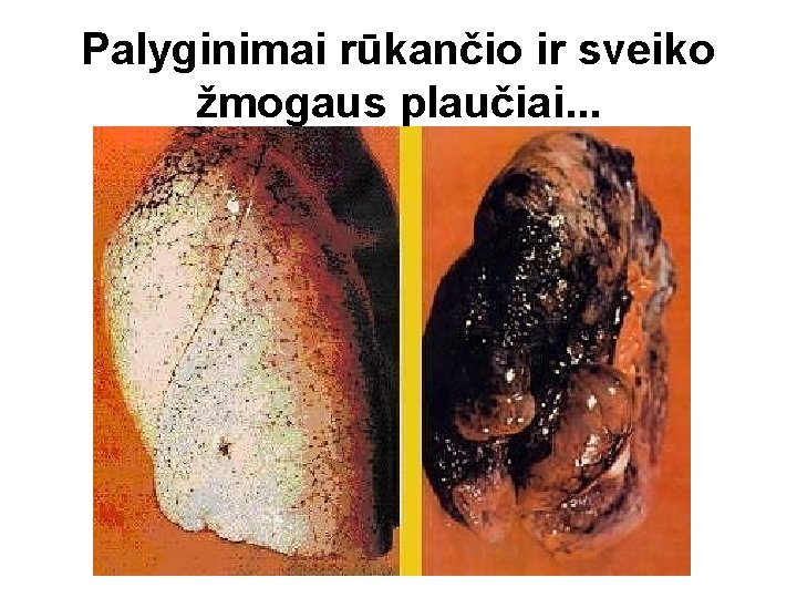 Palyginimai rūkančio ir sveiko žmogaus plaučiai. . . 