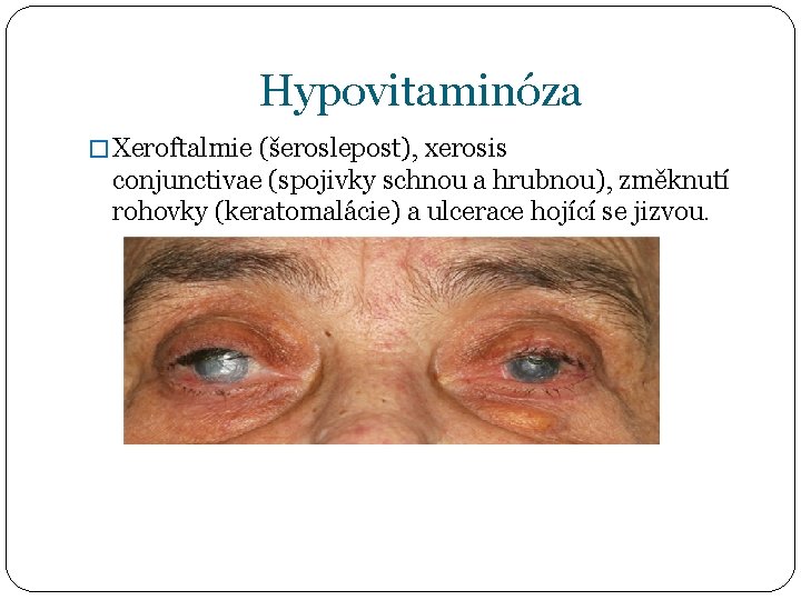 Hypovitaminóza � Xeroftalmie (šeroslepost), xerosis conjunctivae (spojivky schnou a hrubnou), změknutí rohovky (keratomalácie) a
