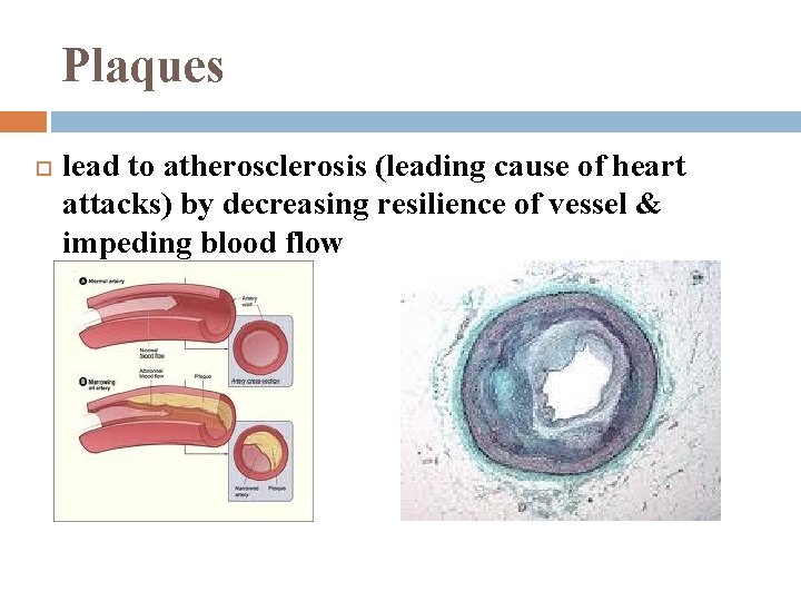 Plaques lead to atherosclerosis (leading cause of heart attacks) by decreasing resilience of vessel