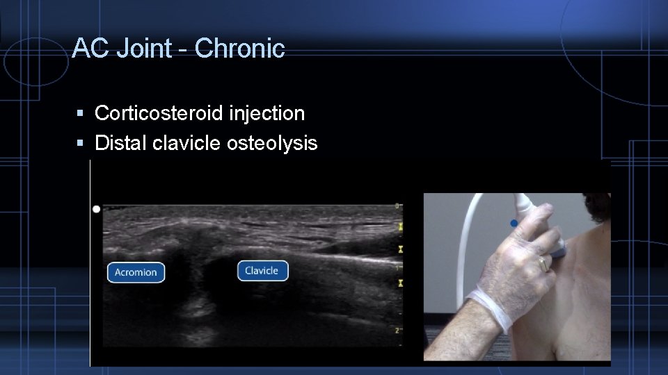 AC Joint - Chronic Corticosteroid injection Distal clavicle osteolysis 