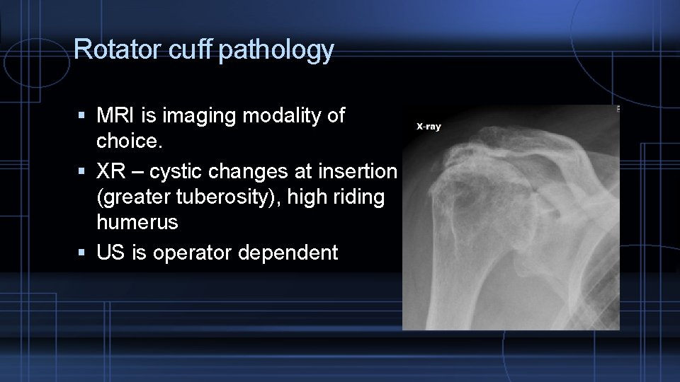 Rotator cuff pathology MRI is imaging modality of choice. XR – cystic changes at