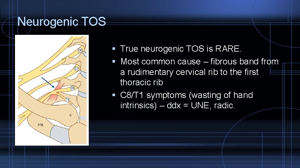 Neurogenic TOS True neurogenic TOS is RARE. Most common cause – fibrous band from