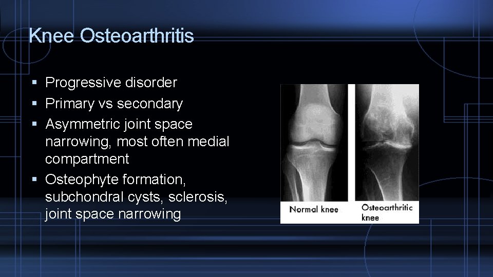 Knee Osteoarthritis Progressive disorder Primary vs secondary Asymmetric joint space narrowing, most often medial