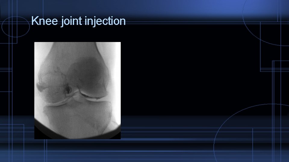 Knee joint injection 