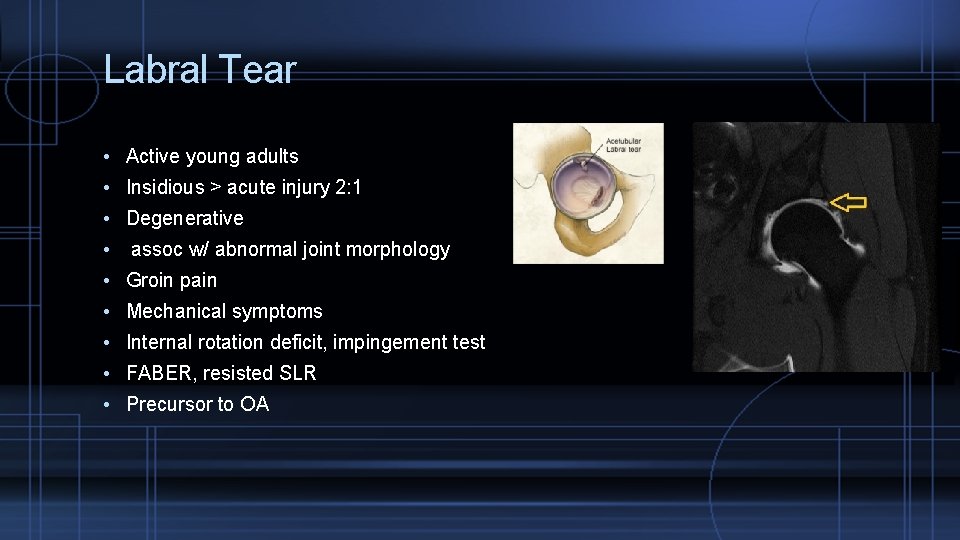Labral Tear • Active young adults • Insidious > acute injury 2: 1 •