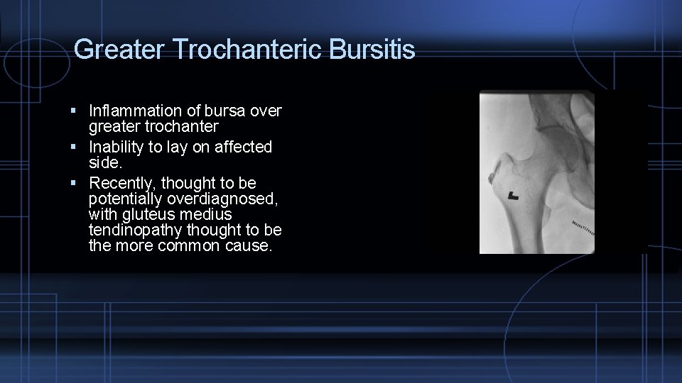 Greater Trochanteric Bursitis Inflammation of bursa over greater trochanter Inability to lay on affected