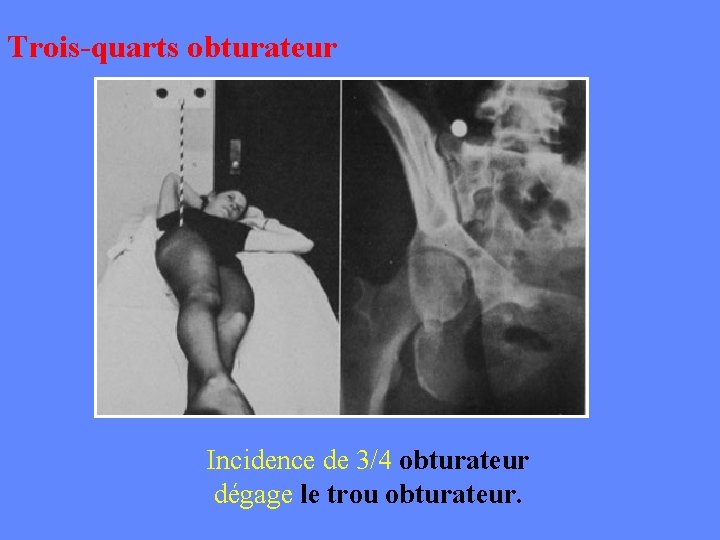 Trois-quarts obturateur Incidence de 3/4 obturateur dégage le trou obturateur. 