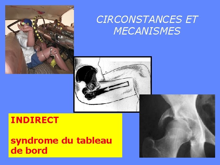 CIRCONSTANCES ET MECANISMES INDIRECT syndrome du tableau de bord 