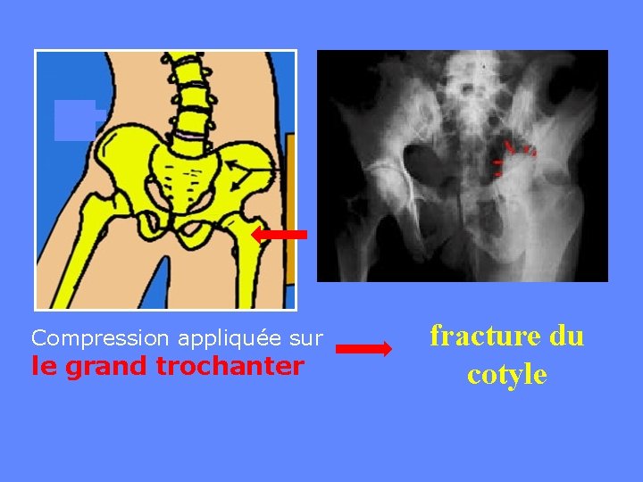 Compression appliquée sur le grand trochanter fracture du cotyle 