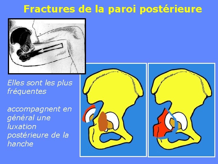 Fractures de la paroi postérieure Elles sont les plus fréquentes accompagnent en général une