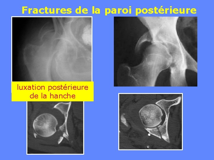 Fractures de la paroi postérieure luxation postérieure de la hanche 
