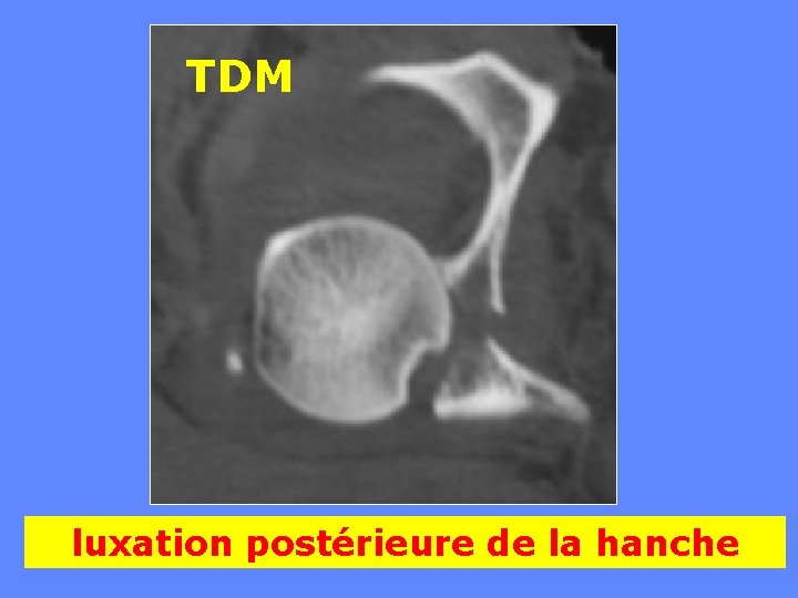 TDM luxation postérieure de la hanche 
