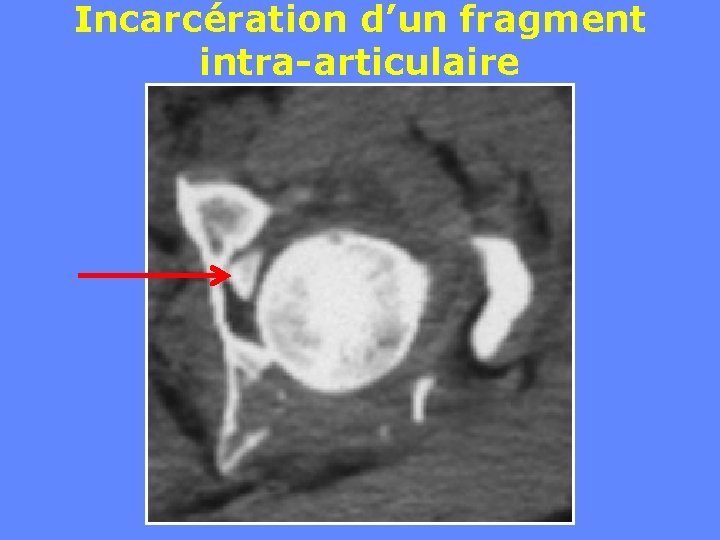 Incarcération d’un fragment intra-articulaire 