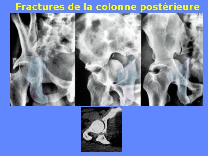 Fractures de la colonne postérieure 