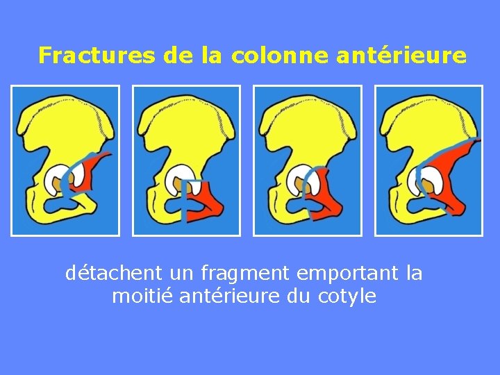 Fractures de la colonne antérieure détachent un fragment emportant la moitié antérieure du cotyle