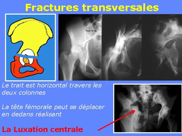 Fractures transversales Le trait est horizontal travers les deux colonnes La tête fémorale peut