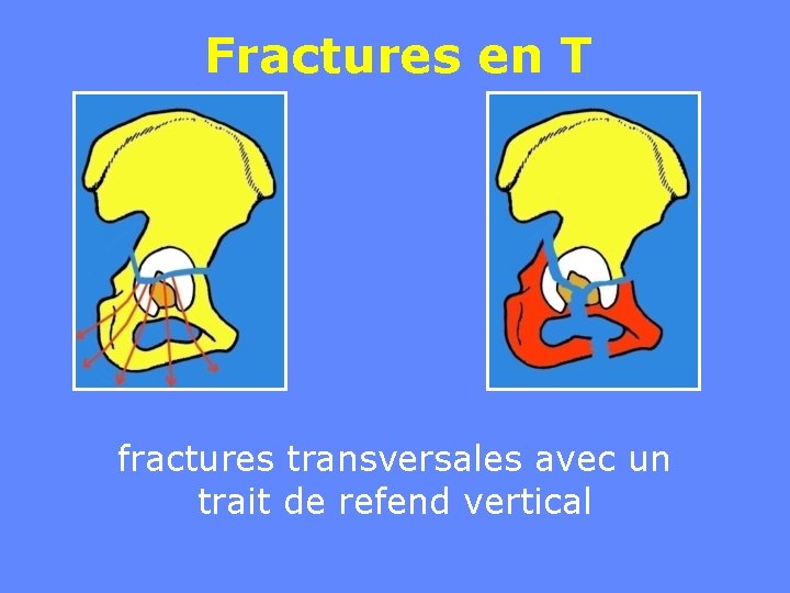 Fractures en T fractures transversales avec un trait de refend vertical 