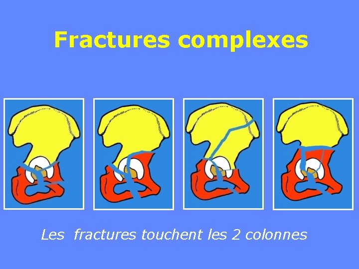 Fractures complexes Les fractures touchent les 2 colonnes 