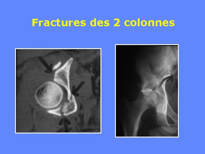 Fractures des 2 colonnes 
