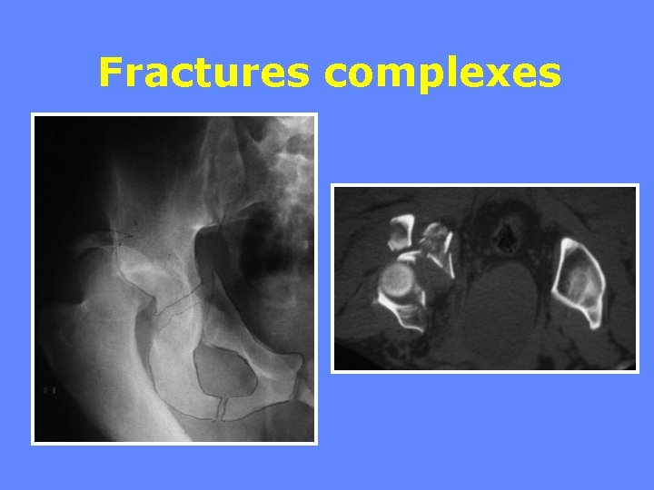 Fractures complexes 