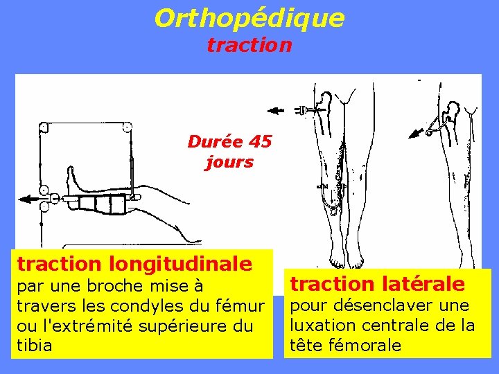 Orthopédique traction Durée 45 jours traction longitudinale par une broche mise à travers les