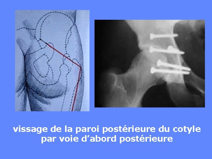 vissage de la paroi postérieure du cotyle par voie d’abord postérieure 