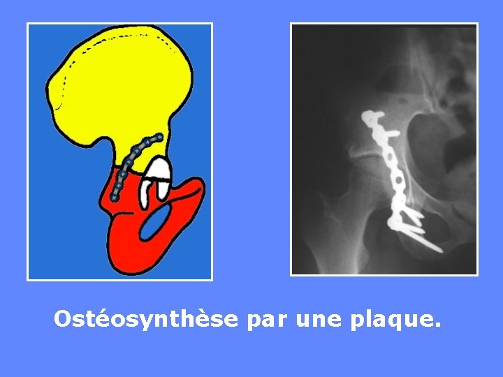 Ostéosynthèse par une plaque. 