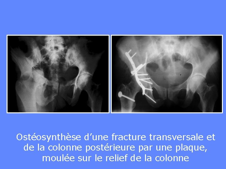 Ostéosynthèse d’une fracture transversale et de la colonne postérieure par une plaque, moulée sur