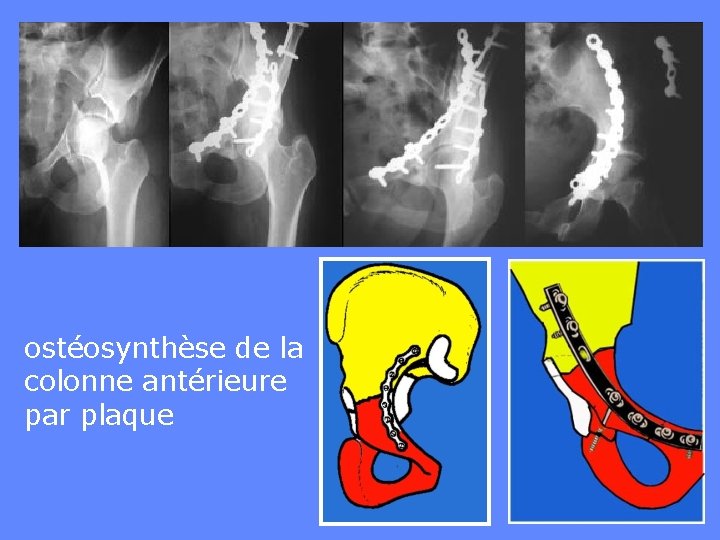 ostéosynthèse de la colonne antérieure par plaque 